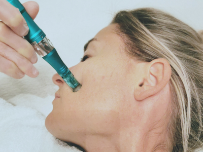 <h2>Vampirlifting</h2>
      Unser Blut als AntiAging Wunder: Ja, denn die Anwendung von plättchenreichem Plasma sorgt für eine Anregung von Kollagen und Elastin in der Haut. Das Ergebnis ist eine frische und straffere Haut, die strahlt. 
Auch bei Narben und Pigmentflecken erzielen wir wunderbare Ergebnisse.
Das Plasma wird mit einem Microneedling Pen in die Haut eingearbeitet. Dadurch entstehen mikrofeine Verletzungen, die der Haut einen Impuls geben neue und frische Zellen und Kollagen  zu produzieren.
Es kommt zu einer Rötung, die am nächsten Tag größtenteils verschwunden ist.
Die Anzahl der Behandlungen ist individuell. Ich empfehle 2-3 Sitzungen im Abstand von 4-6 Wochen.